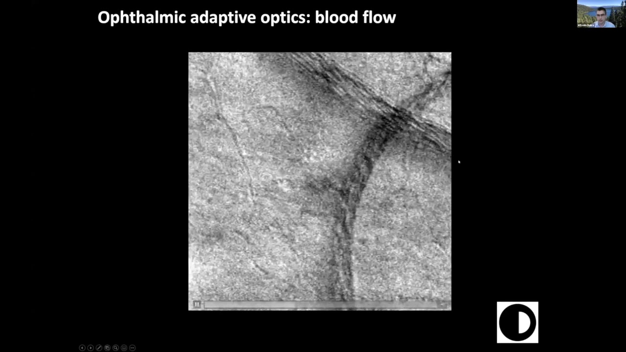 Adaptive optics imaging of optic neuropathies