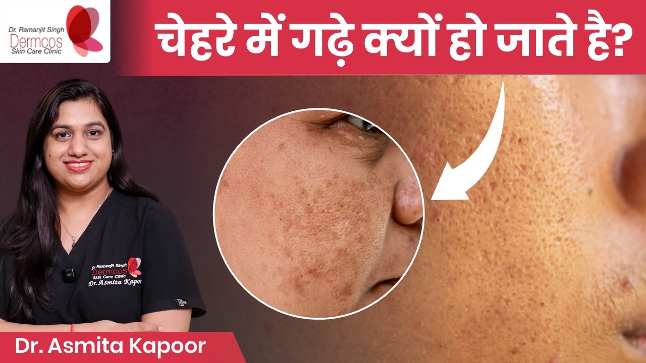 चेहरे पर गढ़े क्यों होते है? Acne Scar Treatment in Hindi | Dermcos Skincare Clinic 
