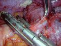Thoracic surgery vats left pneumonectomy