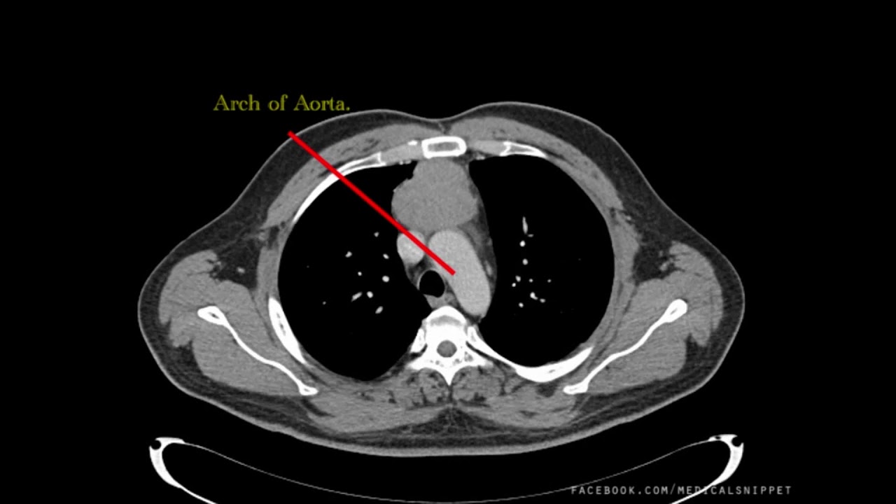 Ct Thorax How To Read Youtube