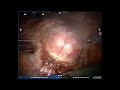 V10-02: Robotic partial nephrectomy with reversible selective artery endoluminal balloon occlusion