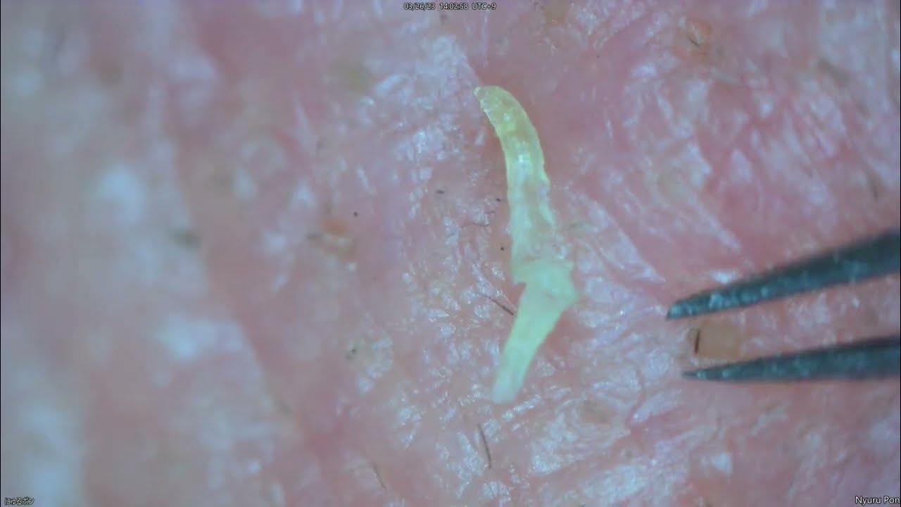 0184 keratin plug removal nose YouTube