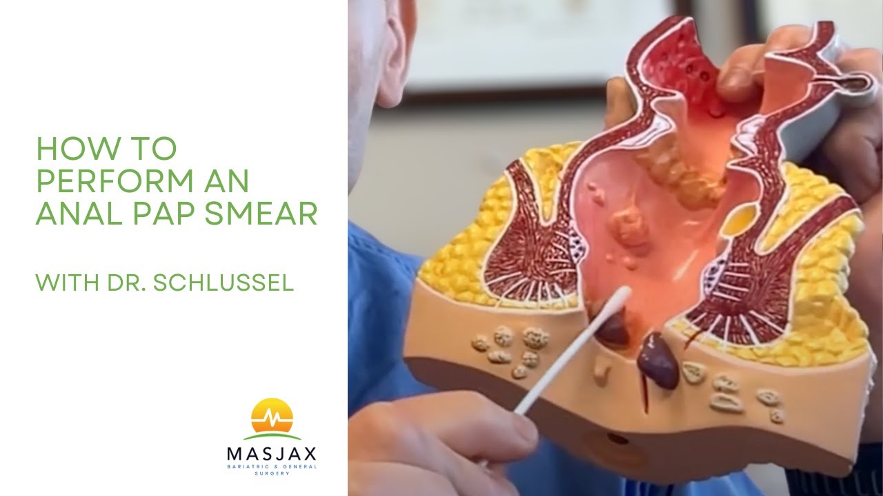 🔬 How to Perform an Anal Pap Smear: The Simple Test That Could Save