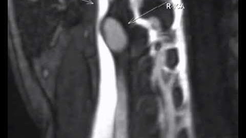 CCSVI Multiple sclerosis Breakthrough cure   YouTube