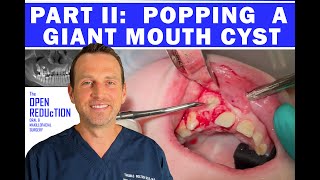 POPPING a GIANT MOUTH CYST PART 2 the FULL SURGERY #cystpoping