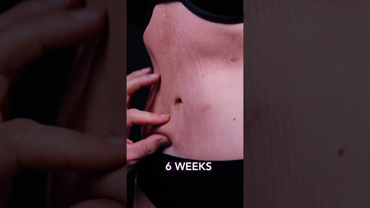 Lipo360 with Renuvion 6 wks Postop | Dr. Machado 