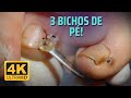 BICHO DE PÉ 4K (FOOT BUG IN 4K) - PODÓLOGO MAURÉLIO