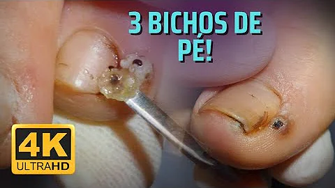 Qual o médico que cuida de unha encravada?