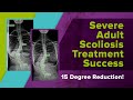 Severe Adult Scoliosis Treatment Success - 15 Degree Reduction!