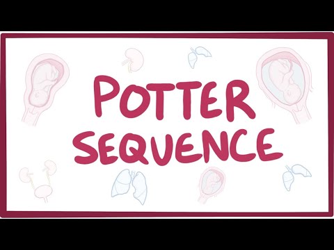 Potter sequence (oligohydramnios) - causes, symptoms, diagnosis, treatment, pathology — video thumbnail