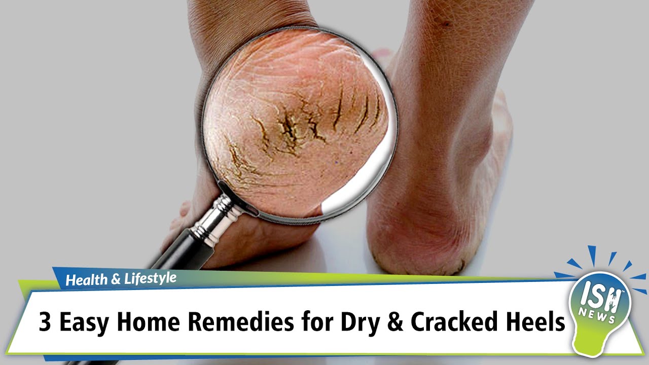 Dry feet and cracked heels: causes and treatment - Salvequick