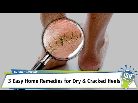 Home Remedy To Get Rid Of Cracked Heels Fast - YouTube