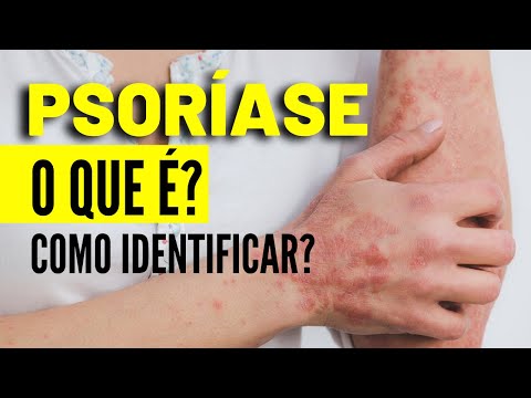 Vídeo: 3 maneiras de diagnosticar a psoríase eritrodérmica