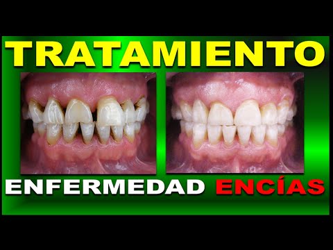 Video: La Enfermedad Periodontal och Los Gatos