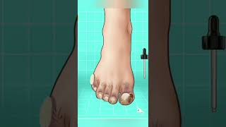 ASMR ingrown toenail removal treatment p1 #asmr #animation #satisfying #viral #shorts #ytshorts