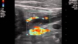 Dilatacao Ducto Pancreatico