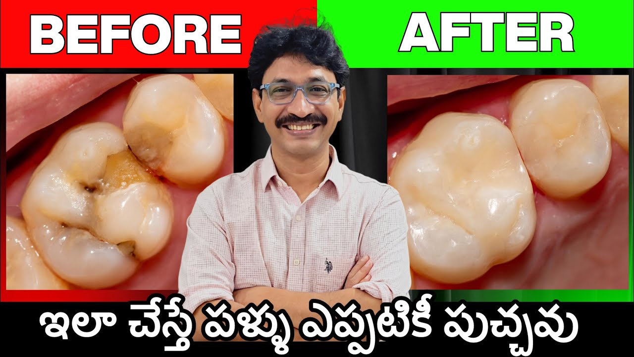 పళ్ళు పుచ్చటం ముందే తెలిస్తే సీక్రెట్ చెప్పేసిన డెంటిస్ట్ #PreventToothDecay #dentisttips #cavity