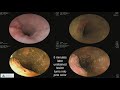 Early Detection of Esophageal Cancer and Barrett’s Esophagus: Recent Advances