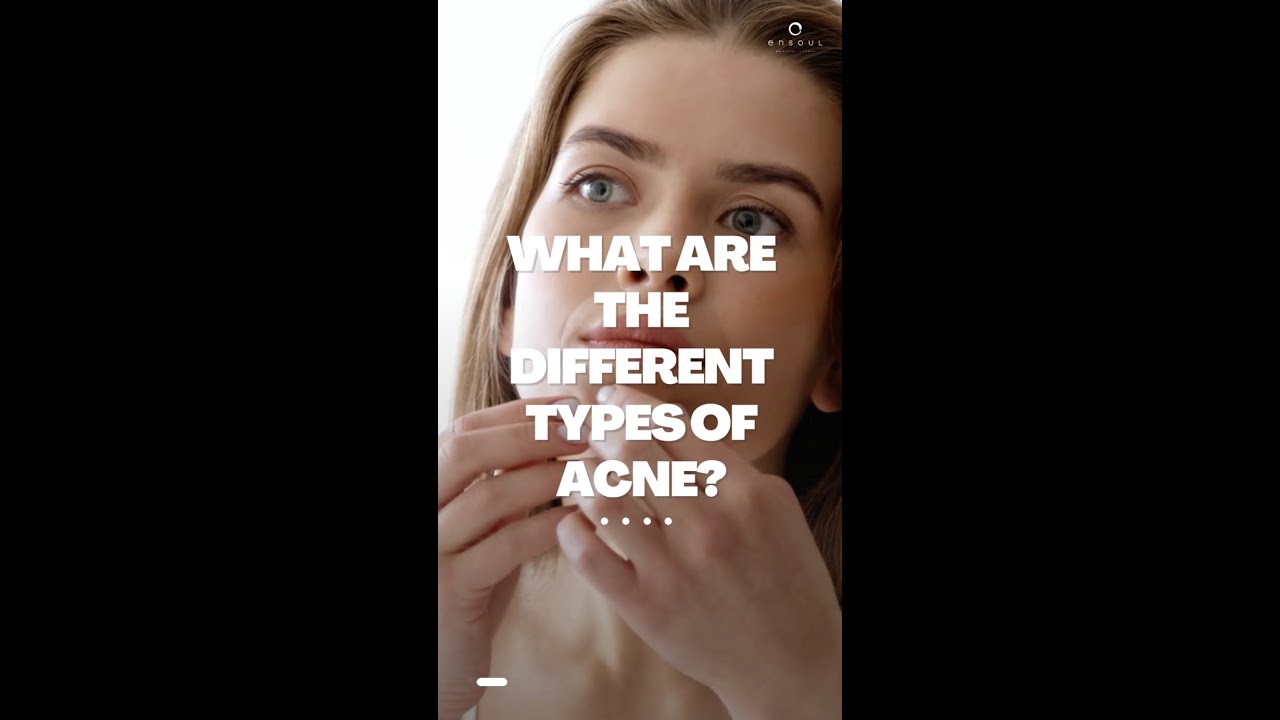 What are the Treatments for noninflammatory acne Ensoul Medical