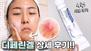 디페린겔 여드름에 진짜 효과 있을까!?