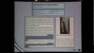 Compression Garment Study - Dr. Fortes Presenting in Panama - PART ONE