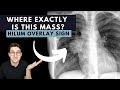 Hilum Overlay Sign Explained
