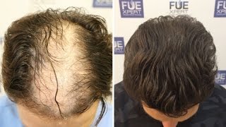 FUE Hair Transplant (4200 Grafts in Advanced Female Pattern) by Dr. Juan Couto - FUEXPERT CLINIC