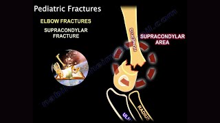 Pediatric Supracondylar Fractures of the humerus  Everything You Need To Know  Dr Nabil Ebraheim