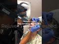 Marking A Blepharoplasty Eyelid Rejuvenation From Bay Area S Top Facial Plastic Surgeons Marking A Blepharoplasty Eyelid Rejuvenation From Bay Area S Top Facial Plastic Surgeons