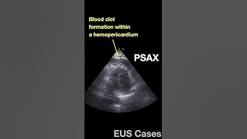 Indirect findings of Type A Aortic Dissection detectable with POCUS