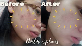 Why Differin Gel Isn't Working for You - Doctor explains