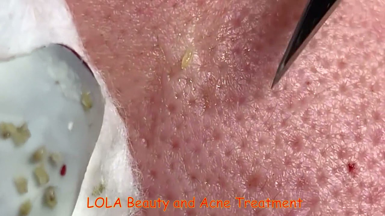 A Bunch of Small Craters; Acne Removal 76;  (Full Screen)  Super Big Pops