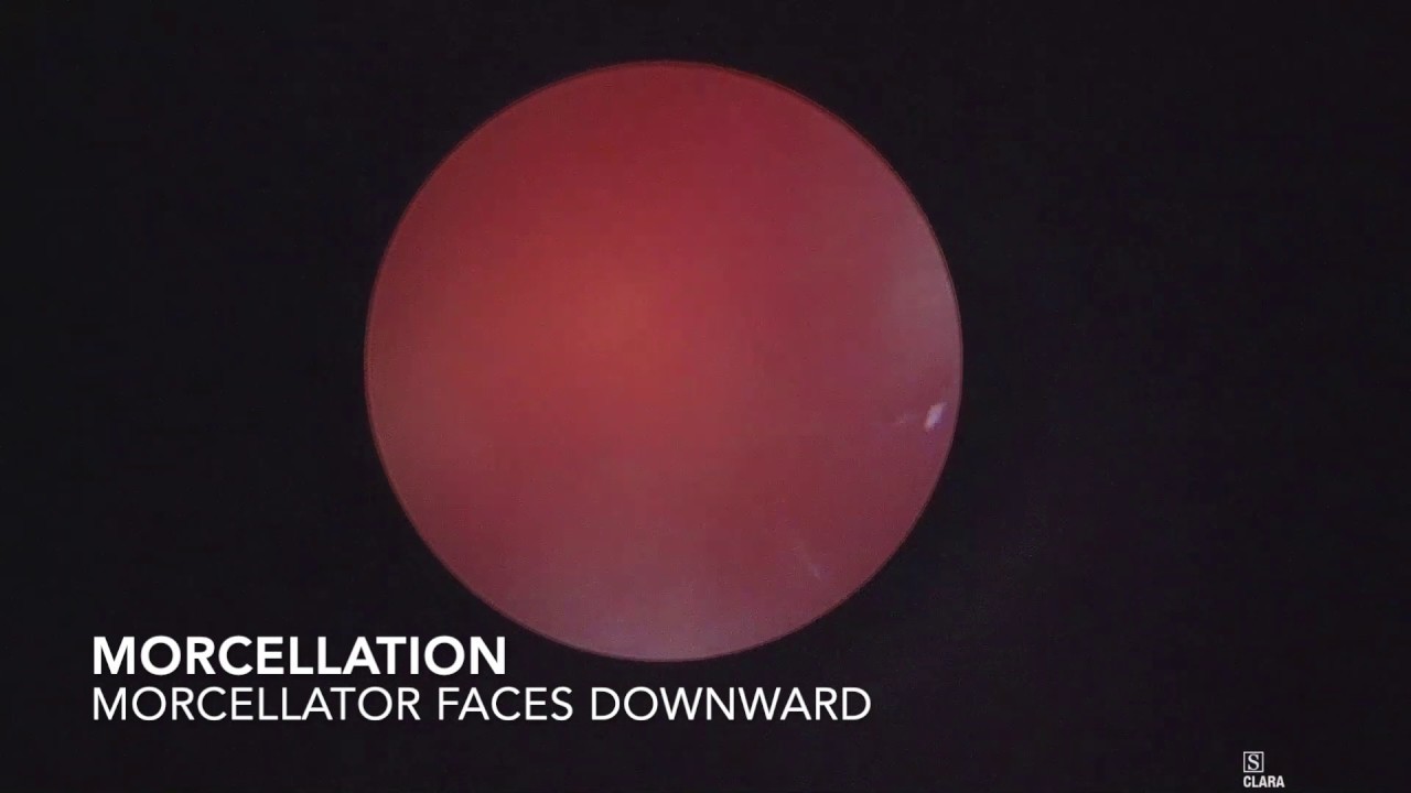 Holep Defect HoLEP Morcellation tips - YouTube
