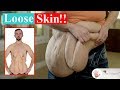 Weight Loss ~ They Refuse to Hide Their Loose Skin ~ Part 2! ~ Body Bizarre