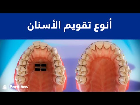 فيديو: ما الذي يسبب الأسنان المعوجة؟