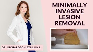Can We Remove A Benign Breast Lump Without Surgery? Yes. Dr. Richardson Explains