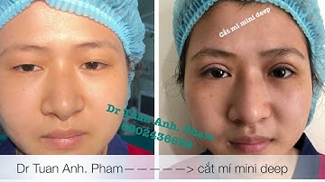 Toàn bộ quá trình cắt mí Mini Deep - DR.ANH PHAM