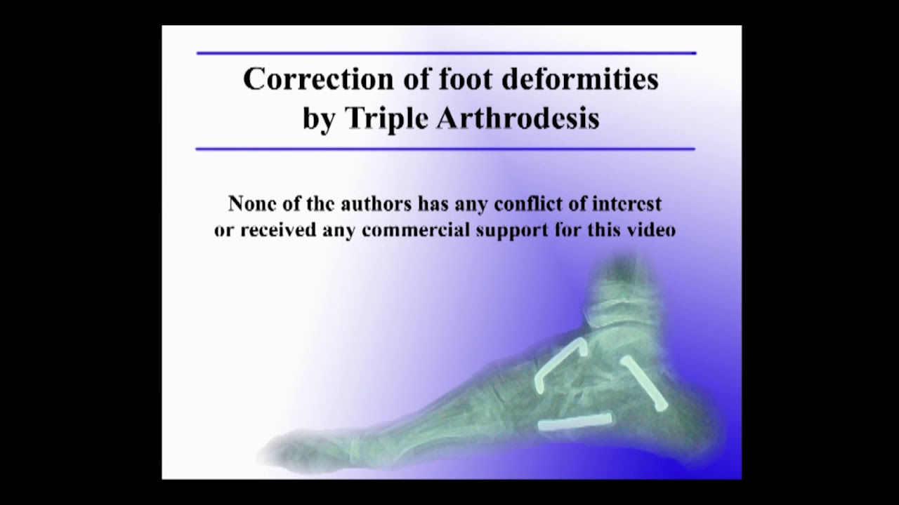 Correction of foot deformities with Triple arthrodesis YouTube