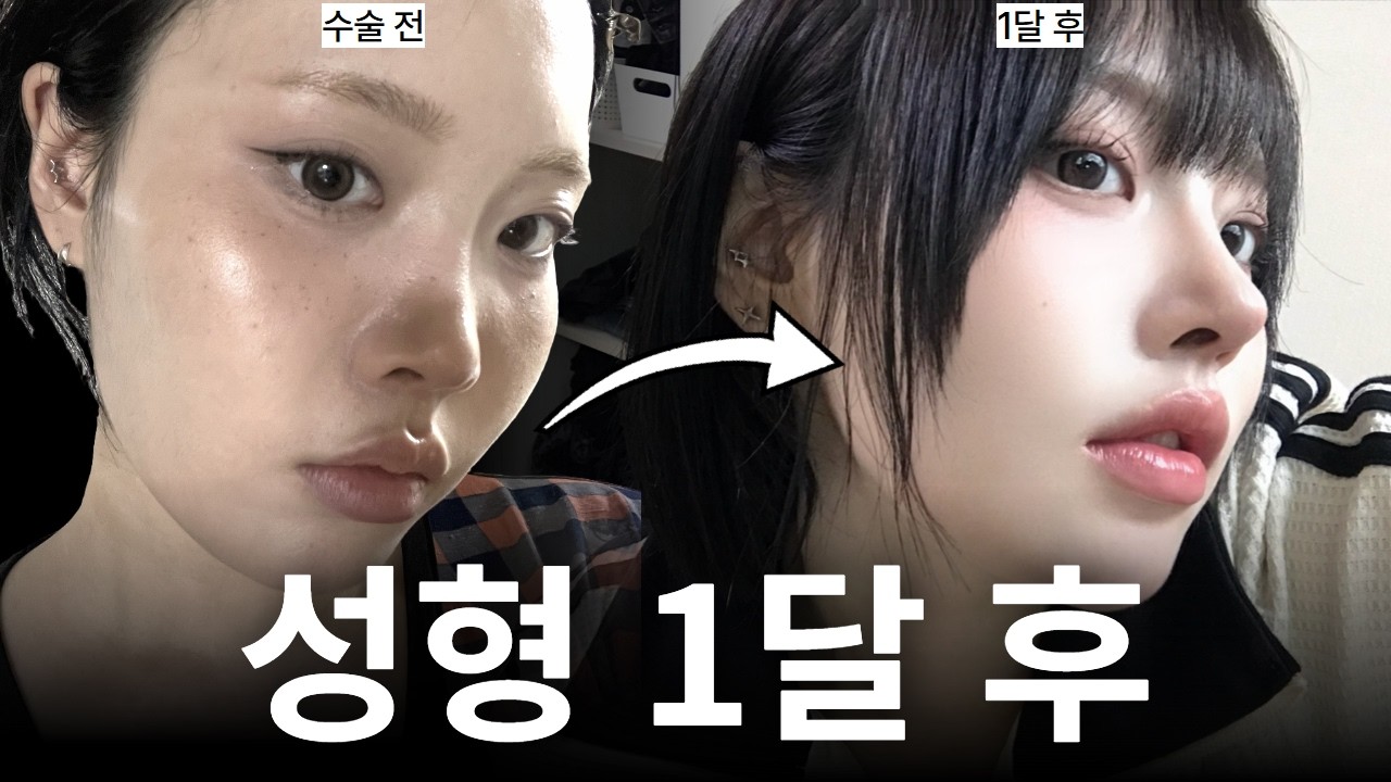 [Вондерфул гоо сайхны мэс заслын эмнэлэг] Нүд, хамрын мэс засал хийлгэсэн. Мэс заслын өмнөх болон дараахыг бүгдийг нь үзүүлнэ.