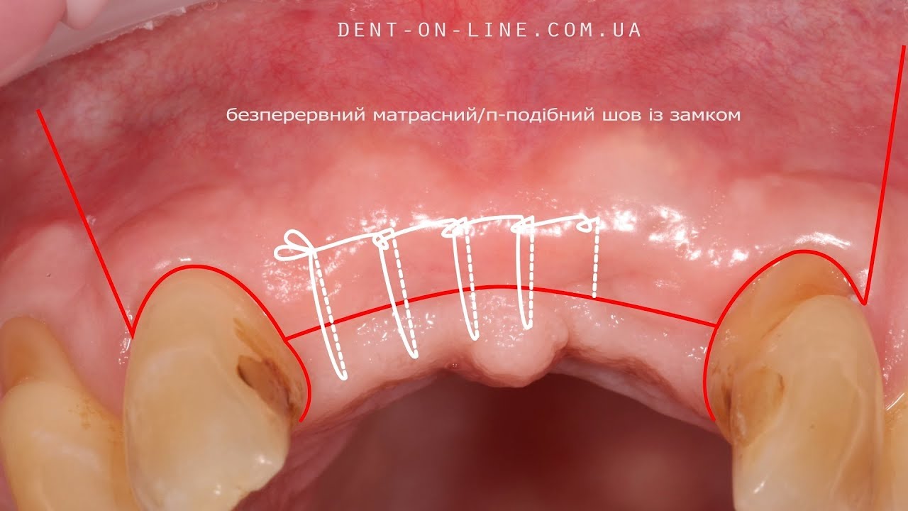 Види швів в стоматології/Dental sutures/Зашивание десны YouTube