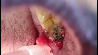 Removing a very rotten wisdom tooth