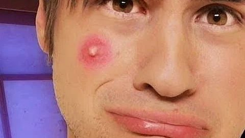 Pimple acne treatment & Pimple doctor - Blackhead