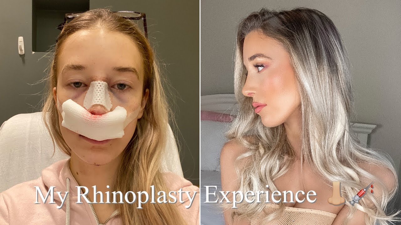 My Nose Job & Chin Augmentation Experience YouTube