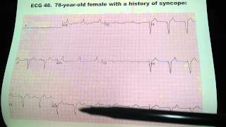 Syncope EKG ECG Electrocardiogram Dr. Benzur