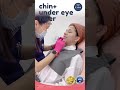 Chin augmentation under eye filller yada clinic pattaya