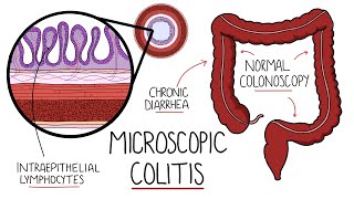 Microscopic Colitis (Lymphocytic & Collagenous Colitis) - An Underdiagnosed Form of IBD