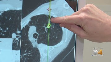 New Technology Could Help Detect Lung Cancer Earlier