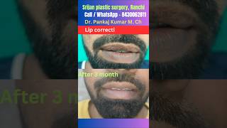 perfection in lip reduction surgery| Lip reduction surgery in Ranchi| Best lip reduction surgery