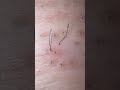 長め動画です #hairremoval #satisfying #tweezers #ingrownhair #blackheads #plucking #extractionshooter