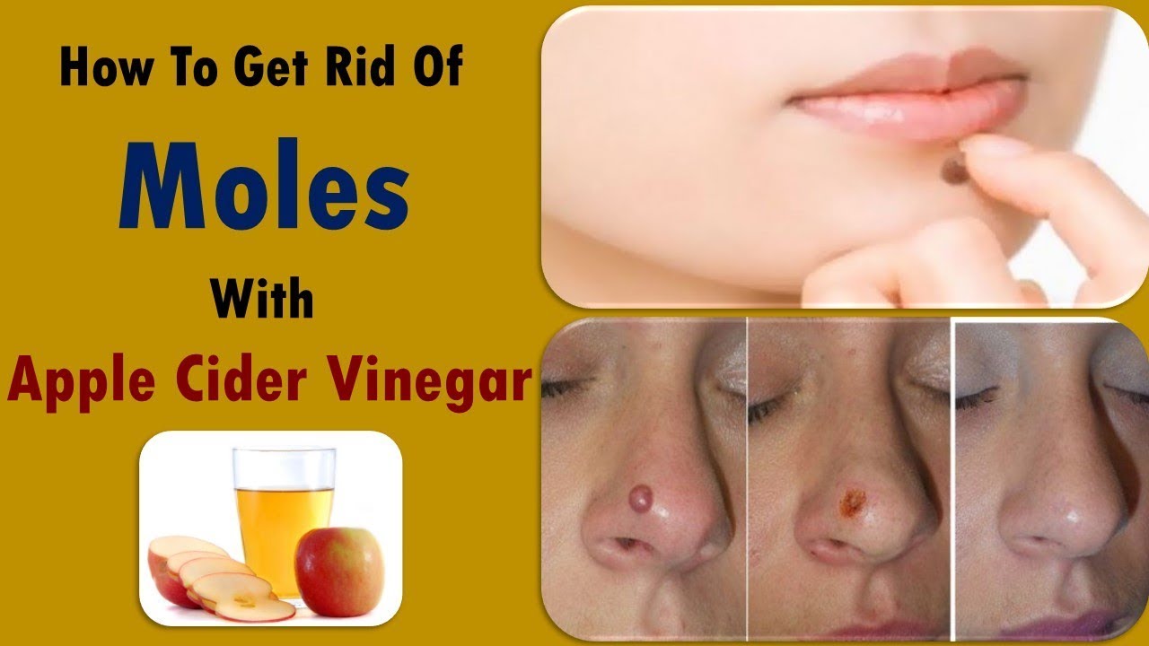 Tips To Remove Moles With Apple Cider Vinegar How To Get Rid Moles